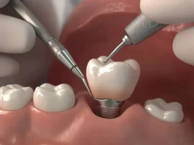 Coroas dentárias: O que você precisa saber para ter um sorriso perfeito