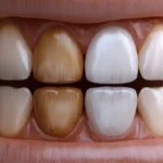 Dentes Manchados: Causas, Prevenção e Tratamentos Eficazes