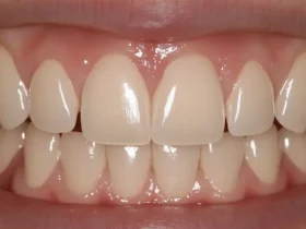 Facetas de porcelana: O que você precisa saber para um sorriso perfeito