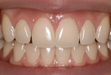 Facetas de porcelana: O que você precisa saber para um sorriso perfeito