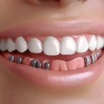 Implante Dentário: Tudo que Você Precisa Saber Para um Sorriso Perfeito