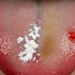 Sinais de Problemas na Língua: Identifique Mudanças Importantes na Sua Saúde